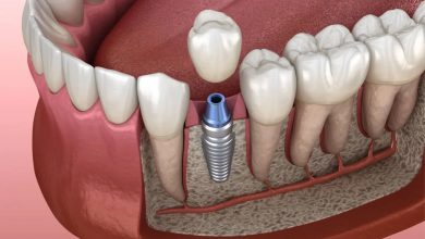 Photo of “Los implantes dentales nos permiten, de forma segura, reponer las piezas dentales perdidas”